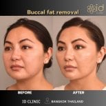 Фото до и после Vaser-липосакции, доктор 