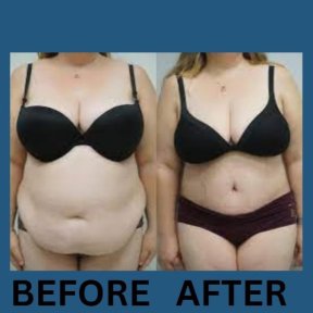 Before and after Vaser 3 areas plus tummy tuck results at ID Clinic Bangkok, body contouring