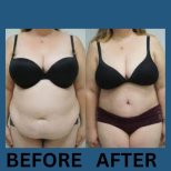 Before and after Vaser 3 areas plus tummy tuck results at ID Clinic Bangkok, body contouring