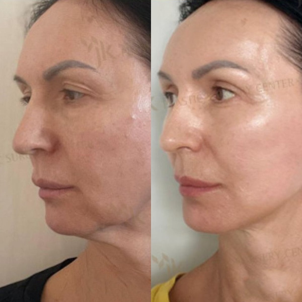 Resultados antes y después de deep plane facelift en JK Plastic Surgery Center, rejuvenecimiento facial