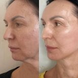 Vorher-nachher-Ergebnis Deep Plane Facelift bei JK Plastic Surgery Center, Gesichtsverjüngung