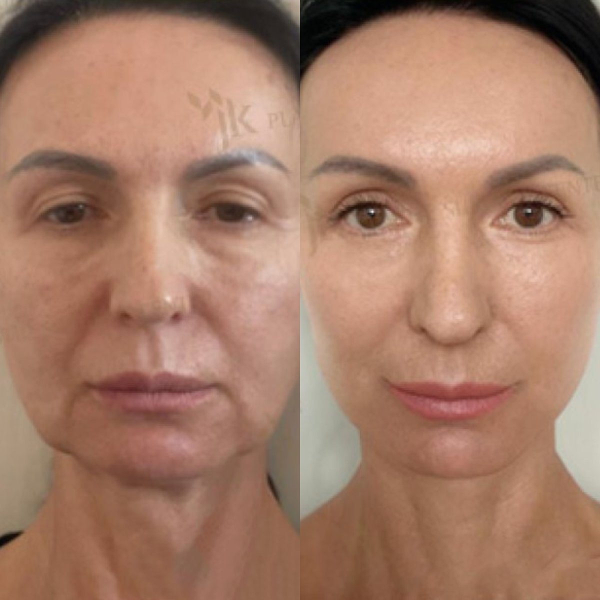 Resultados antes y después de lifting facial profundo en JK Plastic Surgery Center, rejuvenecimiento
