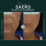 Deep Plane Facelift Vorher-Nachher-Ergebnis bei SAERO Plastic Surgery, sichtbare Kieferlinie