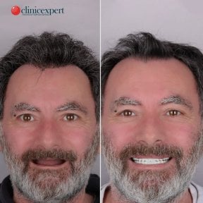 Vorher-nachher-Ergebnis Zahnimplantat bei CE International Hospital, wiederhergestelltes Lächeln