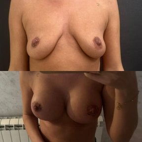 Before and after breast augmentation results at VM Medical Park Florya Hospital, enhanced shape