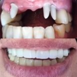 نتائج زراعة الأسنان قبل وبعد في PyraMedicine – ابتسامة وأسنان طبيعية مستعادة