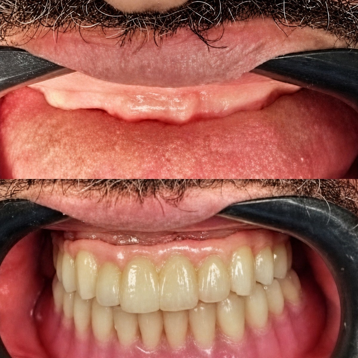 Resultados antes y después de implantes dentales en PyraMedicine: sonrisa restaurada