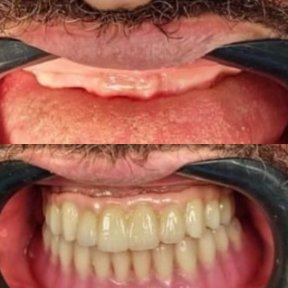 نتائج قبل وبعد زراعة الأسنان في PyraMedicine – استعادة الابتسامة الكاملة