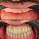 نتائج قبل وبعد زراعة الأسنان في PyraMedicine – استعادة الابتسامة الكاملة