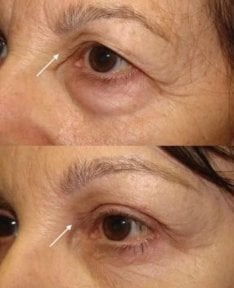 Результаты подтяжки лица до и после в Private Yüzyıl Hospital, уменьшение морщин у глаз