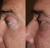 Результаты до и после фейслифтинга в Private Yüzyıl Hospital, видимое омоложение лица