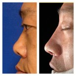 Ethnic rhinoplasty before and after results at Memorial Şişli Hospital, improved nose profile