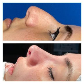 Before and after ethnic rhinoplasty results at Memorial Şişli Hospital, refined nose profile