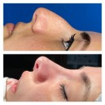 Before and after ethnic rhinoplasty results at Memorial Şişli Hospital, refined nose profile
