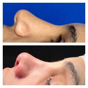 Before and after ethnic rhinoplasty results at Memorial Şişli Hospital, nose reshaping outcome