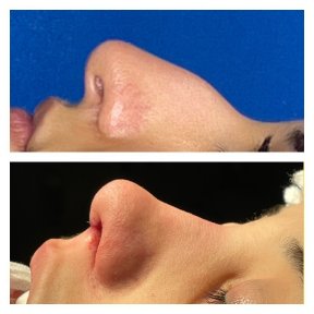 Before and after ethnic rhinoplasty results at Memorial Şişli Hospital, nose reshaping outcome