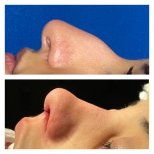 Before and after ethnic rhinoplasty results at Memorial Şişli Hospital, nose reshaping outcome