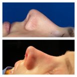 Before and after ethnic rhinoplasty results at Memorial Şişli Hospital, nose reshaping outcome
