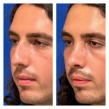 Before and after ethnic rhinoplasty results at Memorial Şişli Hospital, nose reshaping