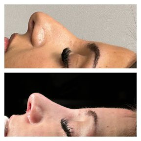 Before and after ethnic rhinoplasty result at Memorial Şişli Hospital, nose reshaping outcome