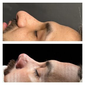 Before and after ethnic rhinoplasty results at Memorial Şişli Hospital, improved nose profile