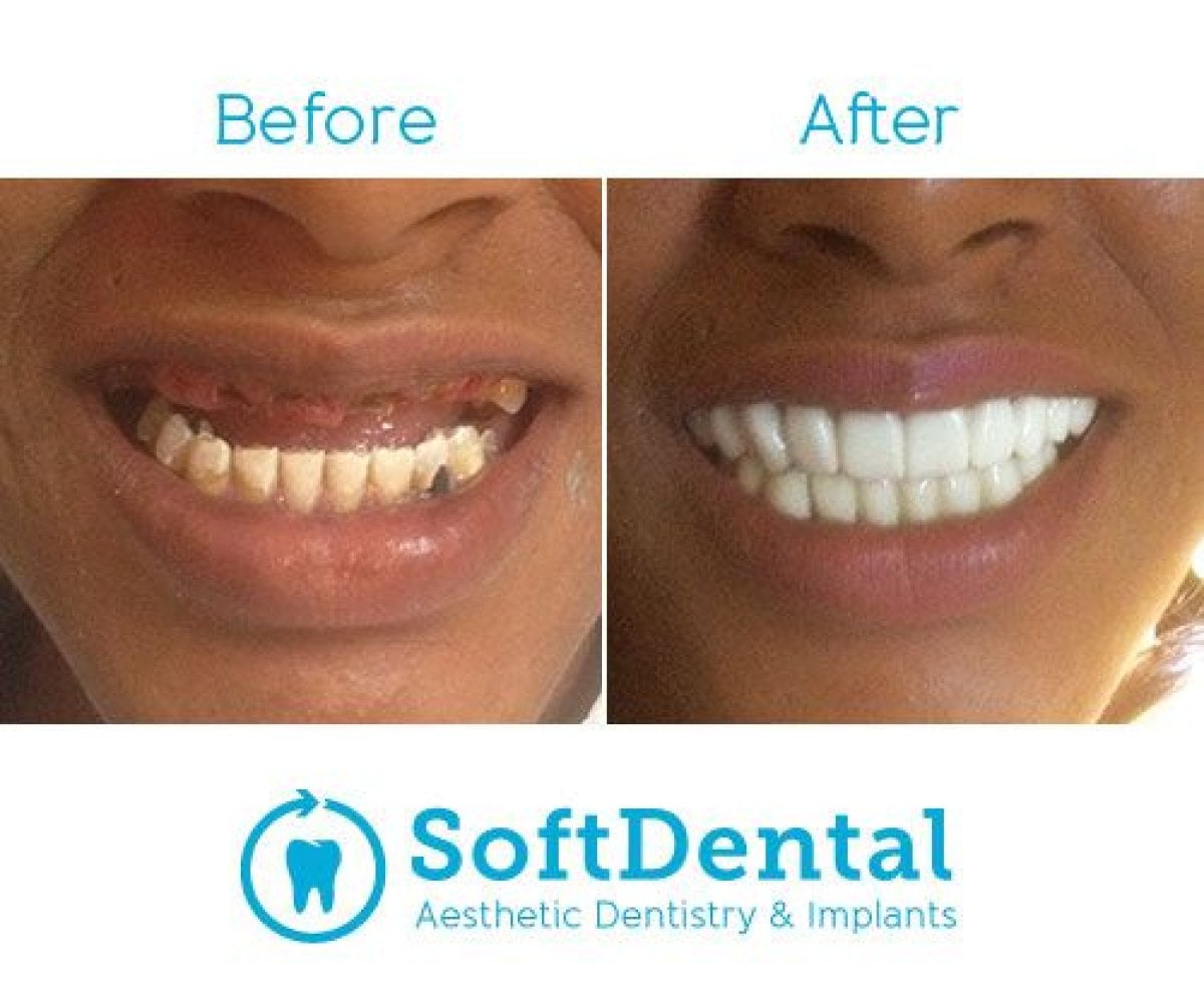 Resultado antes y después de prótesis completas de zirconia en SoftDentalCare Clinic