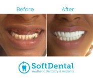 Vorher-nachher-Ergebnis von Vollbogen-Zirkonimplantaten bei SoftDentalCare Clinic