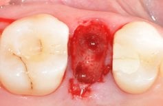 Ділянка після кісткової регенерації зуба в SoftDentalCare Clinic, видимий результат