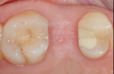 Результат кісткової регенерації зубів у SoftDentalCare Clinic, відновлена ясна