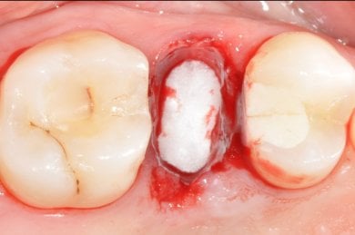 Результат кісткової регенерації зубів у клініці SoftDentalCare, трансплантат між зубами