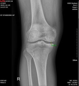أشعة سينية للركبة بعد علاج الخلايا الجذعية في samsungbalance clinic تظهر تحسن المفصل