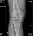 أشعة سينية للركبة بعد علاج الخلايا الجذعية في samsungbalance clinic تظهر تحسن المفصل