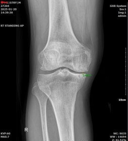 أشعة سينية للركبة قبل علاج الخلايا الجذعية في samsungbalance clinic، يظهر تدهور المفصل