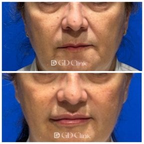Before and after stem cell rejuvenation therapy result at Gangnam Dawoom Clinic [GD Clinic]
