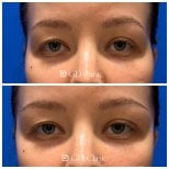Before and after stem cell rejuvenation therapy results at Gangnam Dawoom Clinic [GD Clinic]