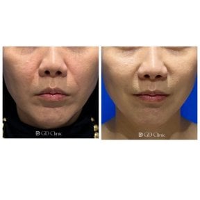 Before and after stem cell rejuvenation therapy results at Gangnam Dawoom Clinic [GD Clinic]