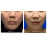 Before and after stem cell rejuvenation therapy results at Gangnam Dawoom Clinic [GD Clinic]