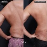 Before and after liposuction results at VG Plastic Surgery, visible back contour improvement