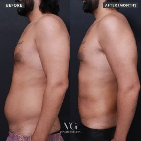 Before and after liposuction results at VG Plastic Surgery, visible abdominal contour improvement