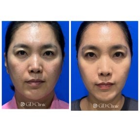 Before and after stem cell rejuvenation therapy results at Gangnam Dawoom Clinic [GD Clinic]