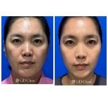 Before and after stem cell rejuvenation therapy results at Gangnam Dawoom Clinic [GD Clinic]