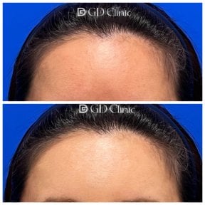 Before and after stem cell rejuvenation therapy results at Gangnam Dawoom Clinic [GD Clinic]