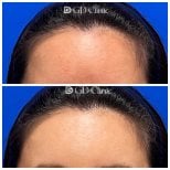 Before and after stem cell rejuvenation therapy results at Gangnam Dawoom Clinic [GD Clinic]
