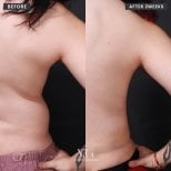 Before and after liposuction results at VG Plastic Surgery, visible waist contour improvement