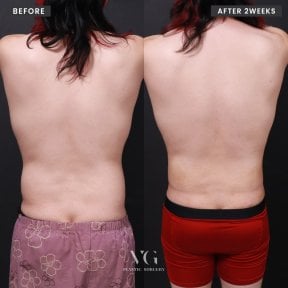 Before and after liposuction results at VG Plastic Surgery, visible back contour improvement