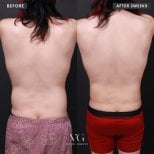 Before and after liposuction results at VG Plastic Surgery, visible back contour improvement