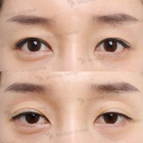 Vorher-nachher-Ergebnisse der Lazy Eyelid Surgery bei JK Plastic Surgery Center, verbesserte Augen