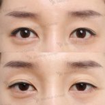 Vorher-nachher-Ergebnisse der Lazy Eyelid Surgery bei JK Plastic Surgery Center, verbesserte Augen