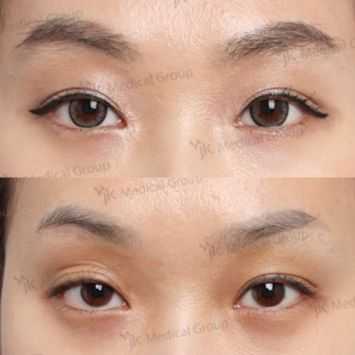 نتائج قبل وبعد جراحة الجفن الكسول في JK Plastic Surgery Center، تحسين شكل الجفن
