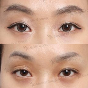 Vorher-nachher-Ergebnisse der Lazy Eyelid Surgery bei JK Plastic Surgery Center, verbesserte Lidkontur